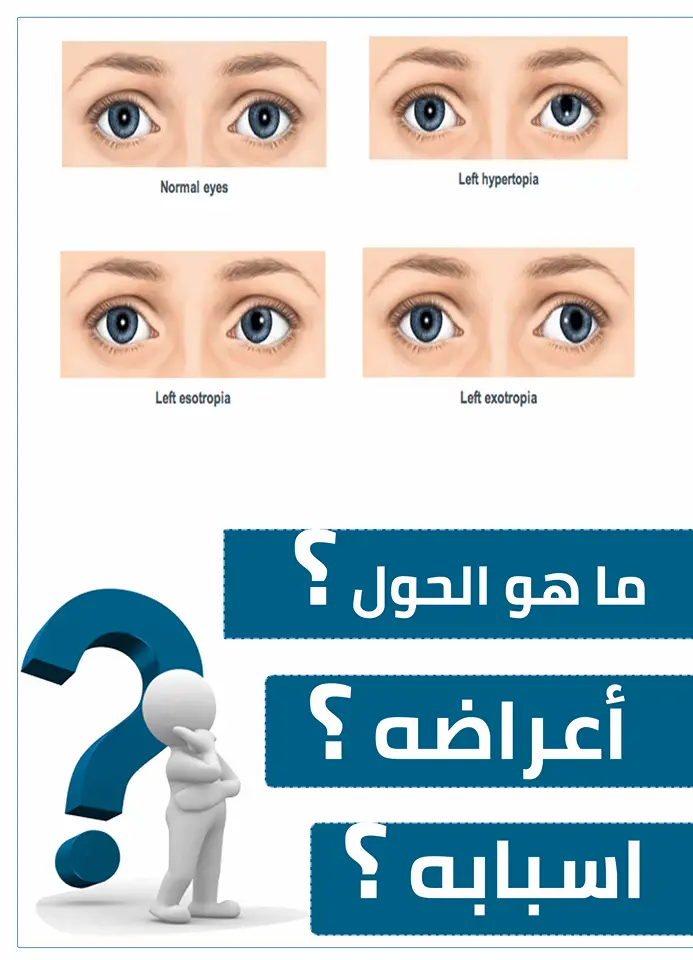 علاج الحول وأهم أسباب حول العين